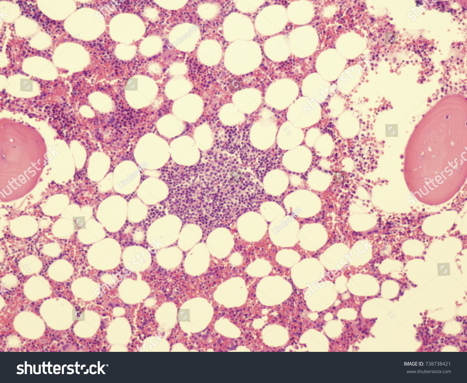 1-interstitial-bone-marrow-infiltration-shutterstock