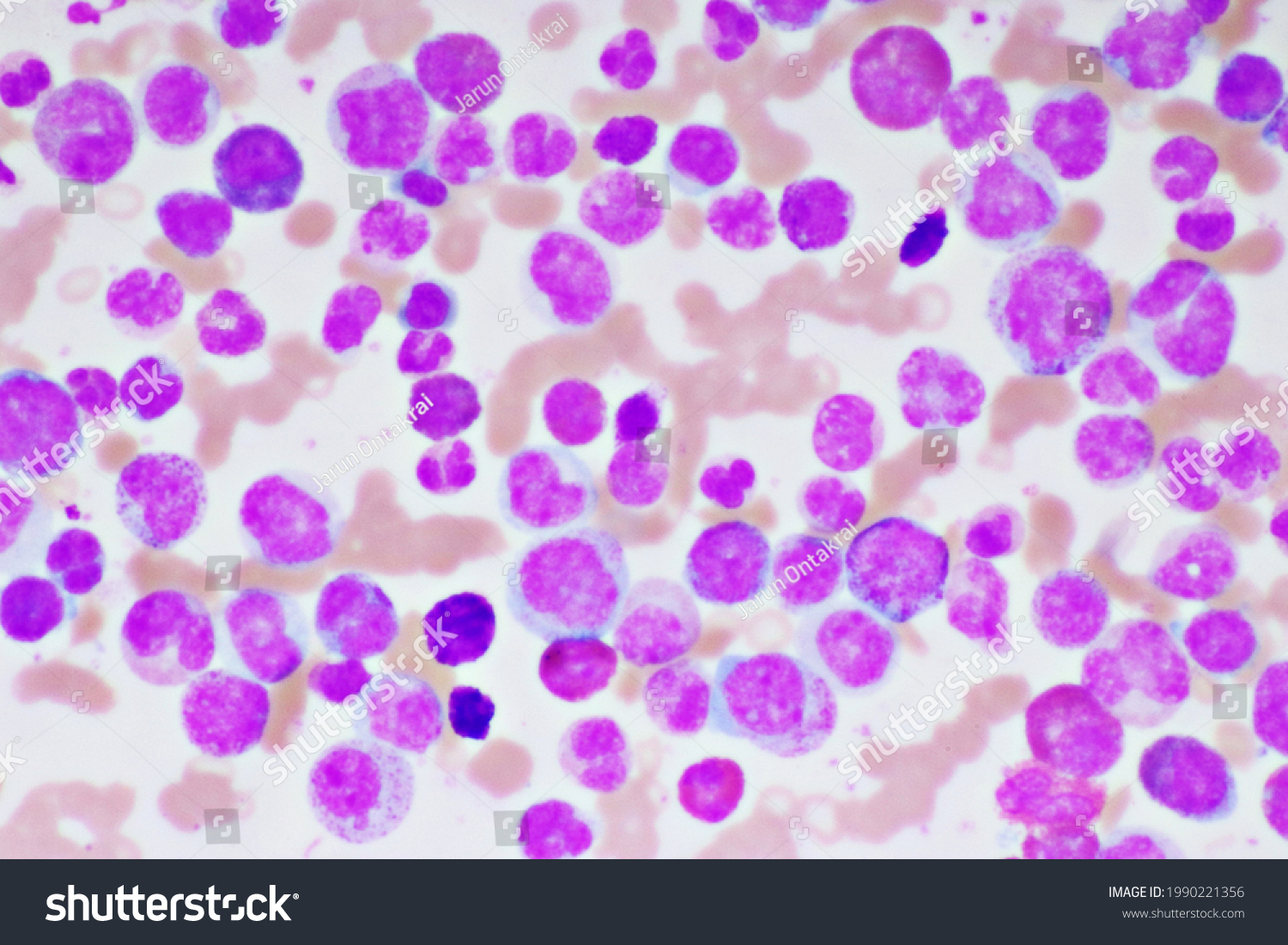 Chronic Myeloid Leukemia Cells Cml Analyze Stock Photo 1990221356 ...