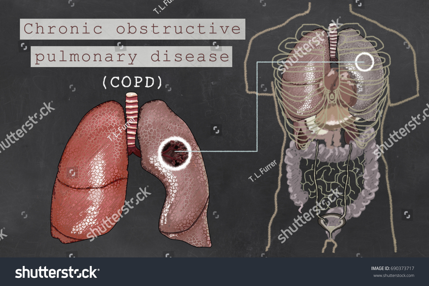 Chronic Obstructive Pulmonary Disease Lungs Torso Stock Illustration ...