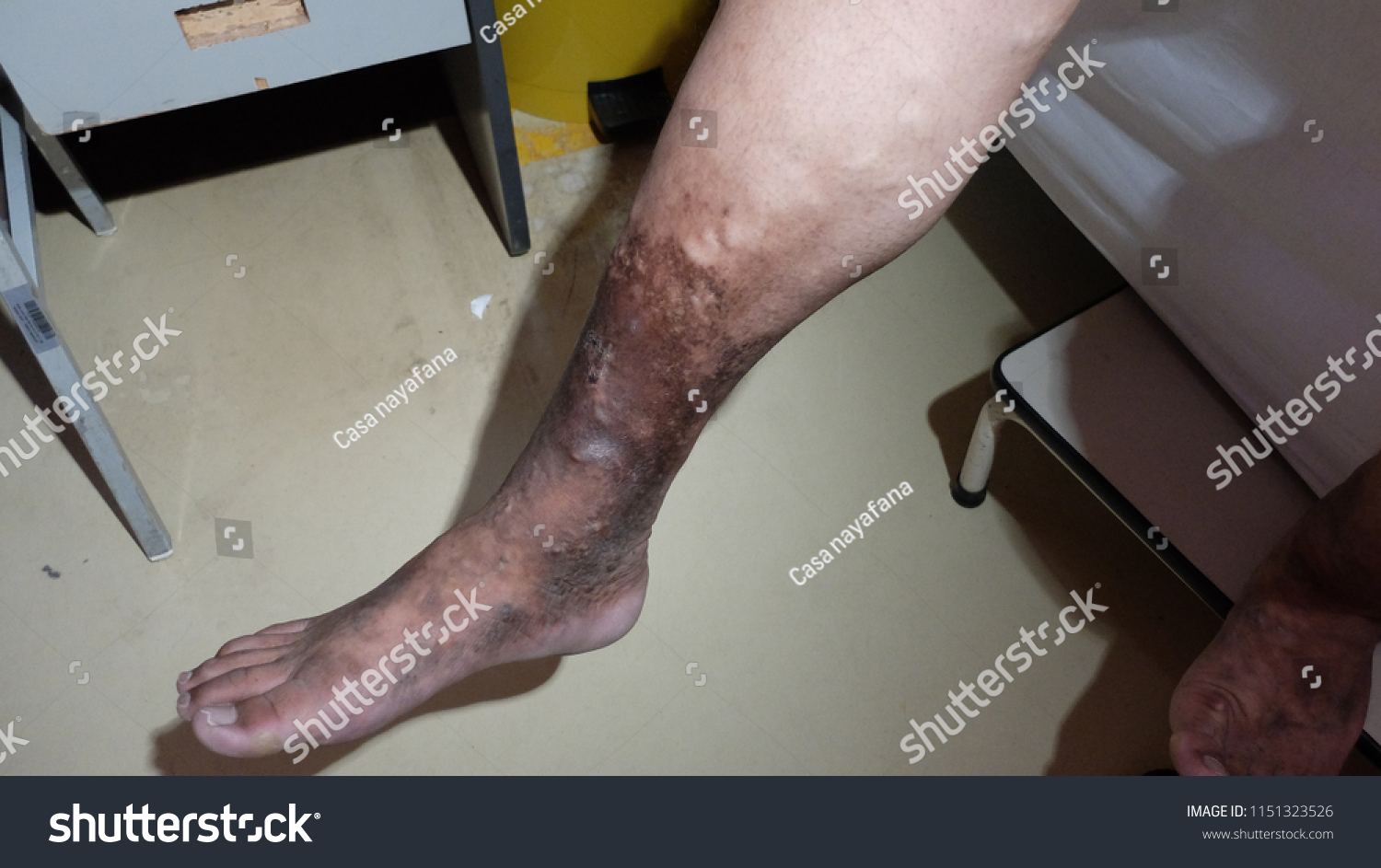 Chronic Venous Insufficiency Varicose Veins Hyperpigmented Stock Photo ...