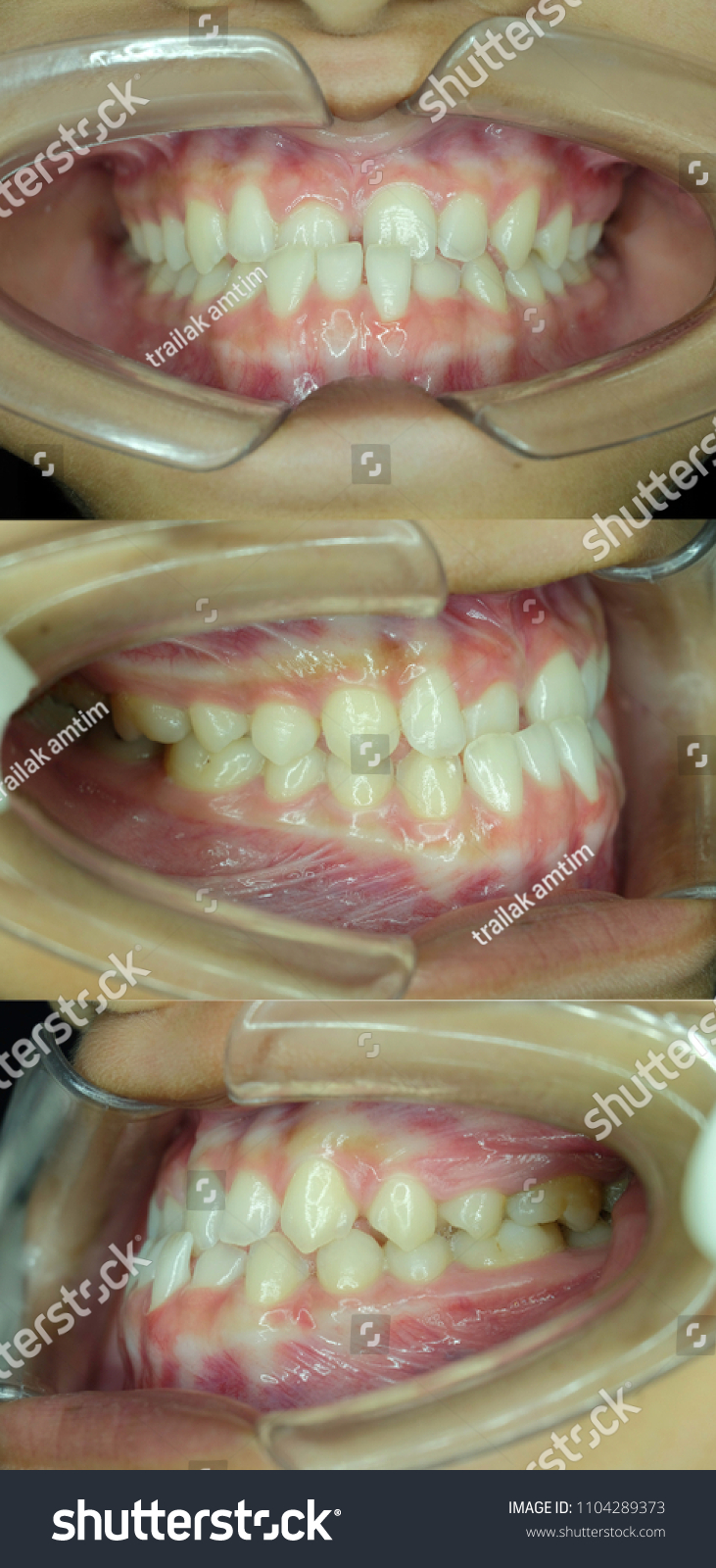 Class Iii Malocclusion Stock Photo Edit Now 1104289373 Class Iii Malocclusion Stock Photo Edit Now 1104289373