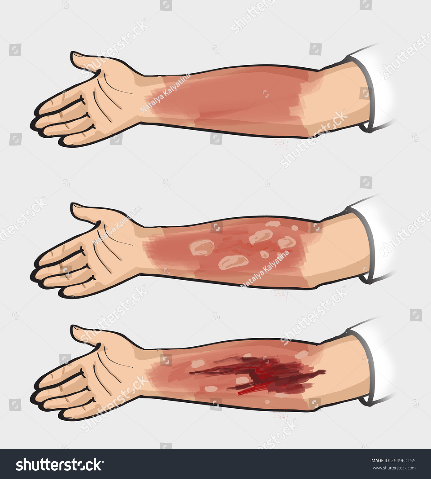 Classification Burns Thermal Injuries Classification Burns Stock ...