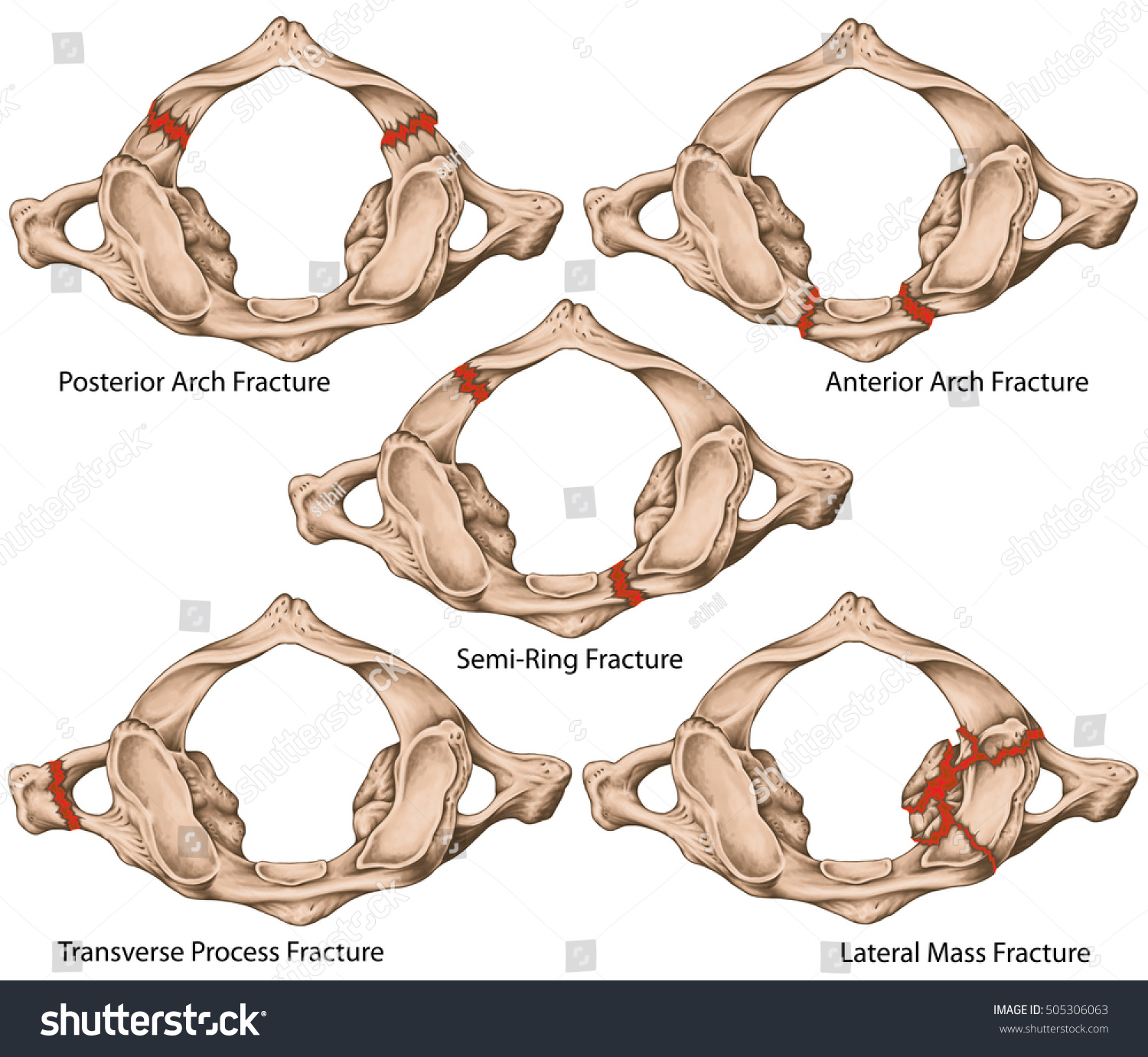 Classification Fractures Atlas Jefferson Fracture Bone Stock ...