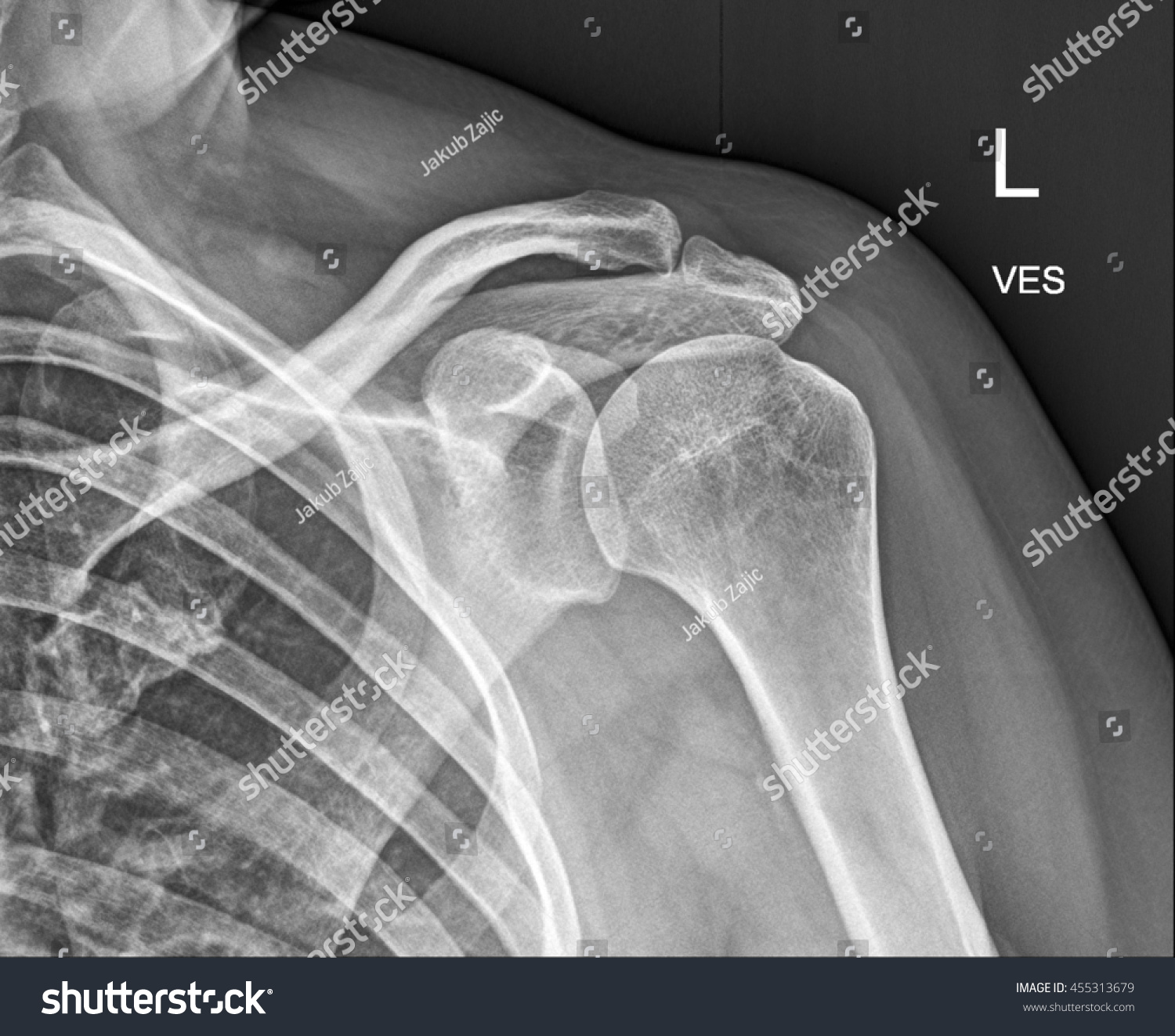 Clavicle Bone, Shoulder Medical Xray Stock Photo 455313679 : Shutterstock