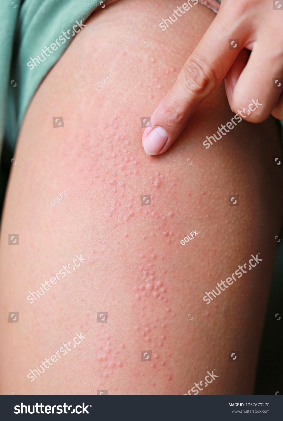 Closeup Allergic Rash Dermatitis Eczema On Foto De Stock Shutterstock