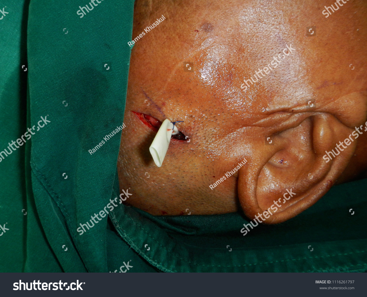 Close Surgical Wound After Incision Drainage Stock Photo Edit Now