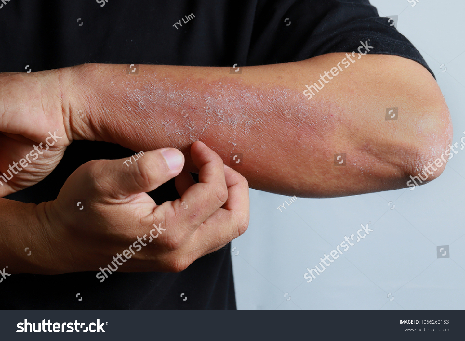 Close Dermatitis On Man Hand Allergic Stock Photo Shutterstock