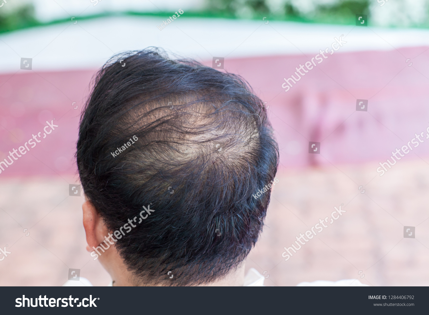 Close Hair Loss Thinning Hair Scalp Stock Photo Edit Now 1284406792
