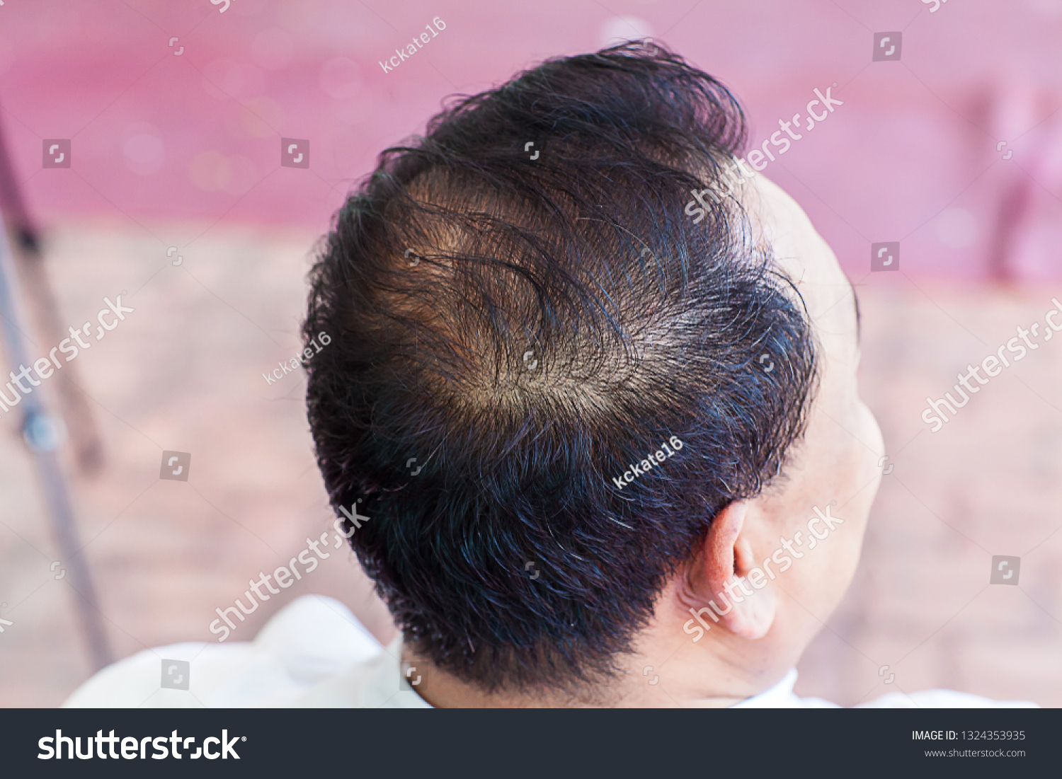 Close Hair Loss Thinning Hair Scalp Stock Image Download Now