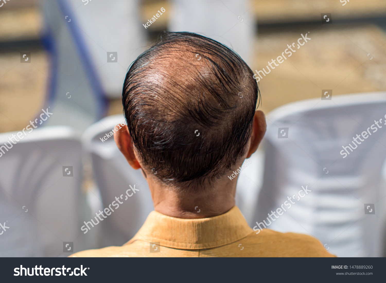 Close Hair Loss Thinning Hair Scalp Stock Photo Edit Now 1478889260