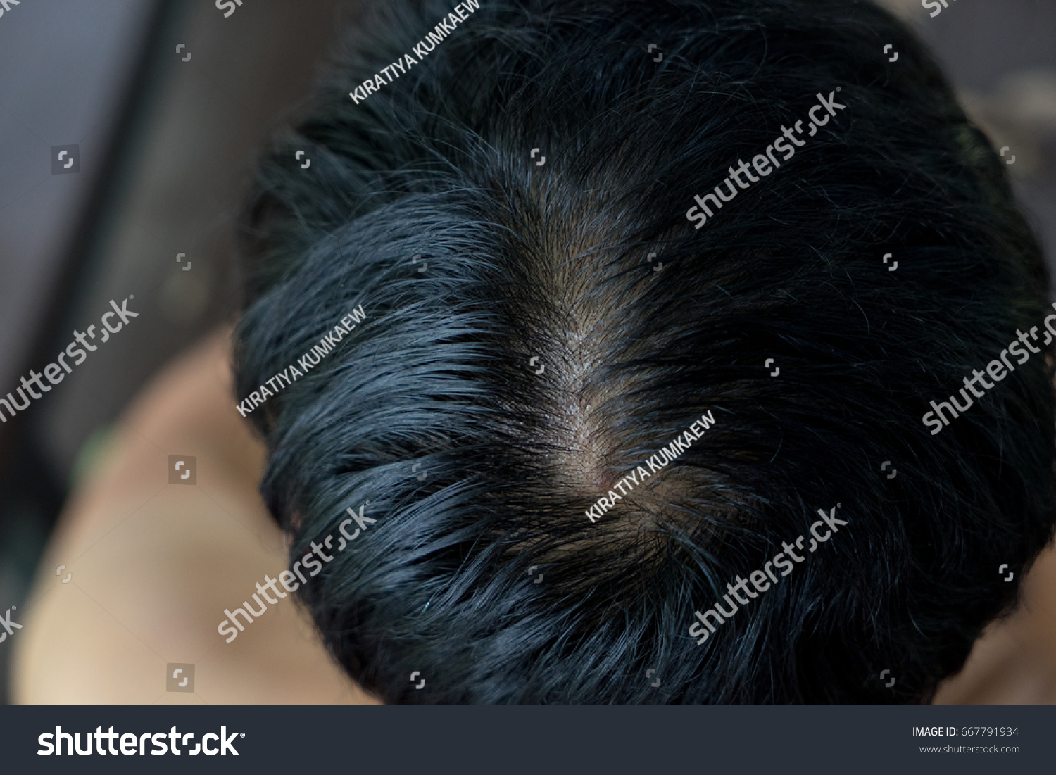 Close Hair Loss Thinning Hair Scalp Stock Photo Edit Now 667791934