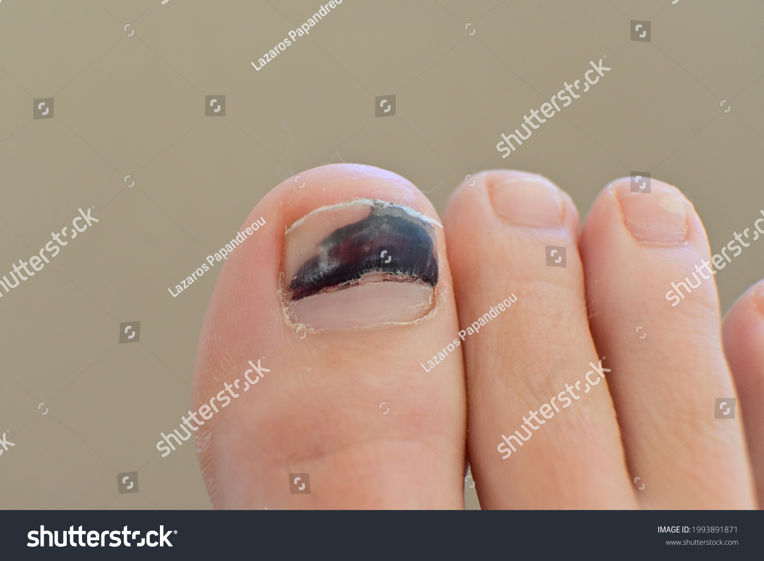 icd 10 code for subungual hematoma right second toe