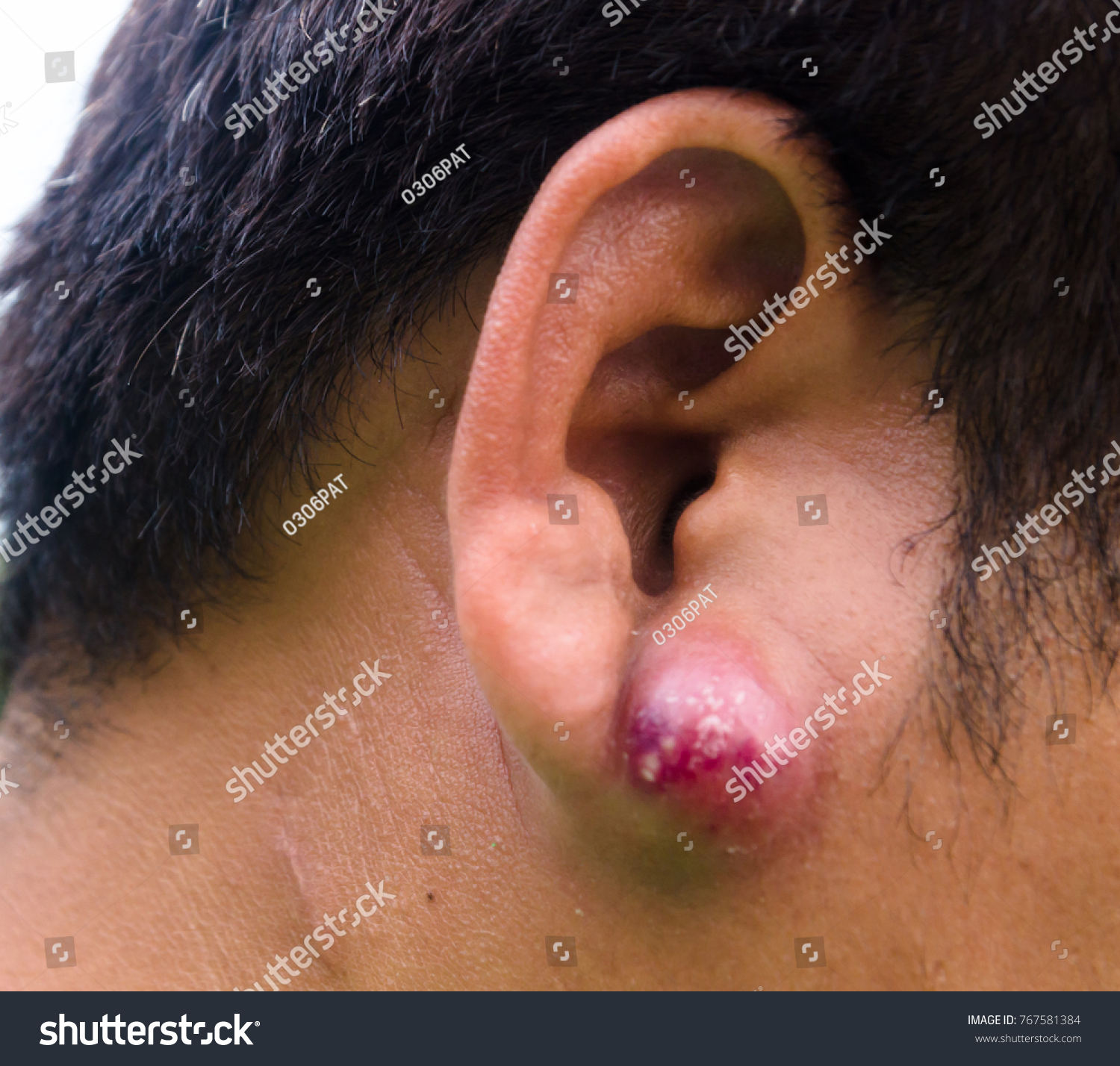 close abscess inflammation on ear area stock photo edit now