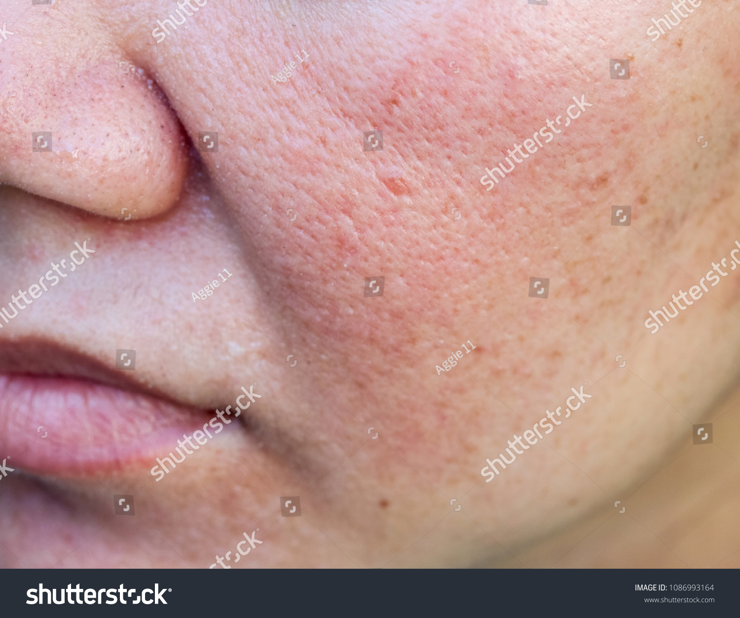 Closeup Acne On Skin Acne On Stock Photo Edit Now 1086993164