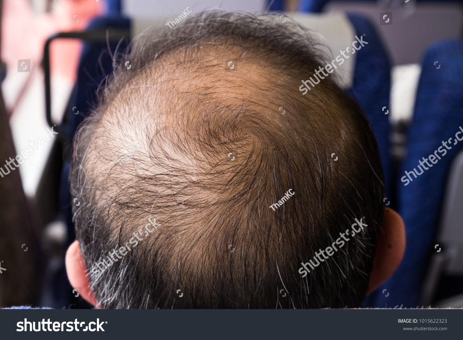 Closeup Balding Thinning Hair Man Crown Stock Photo Edit Now
