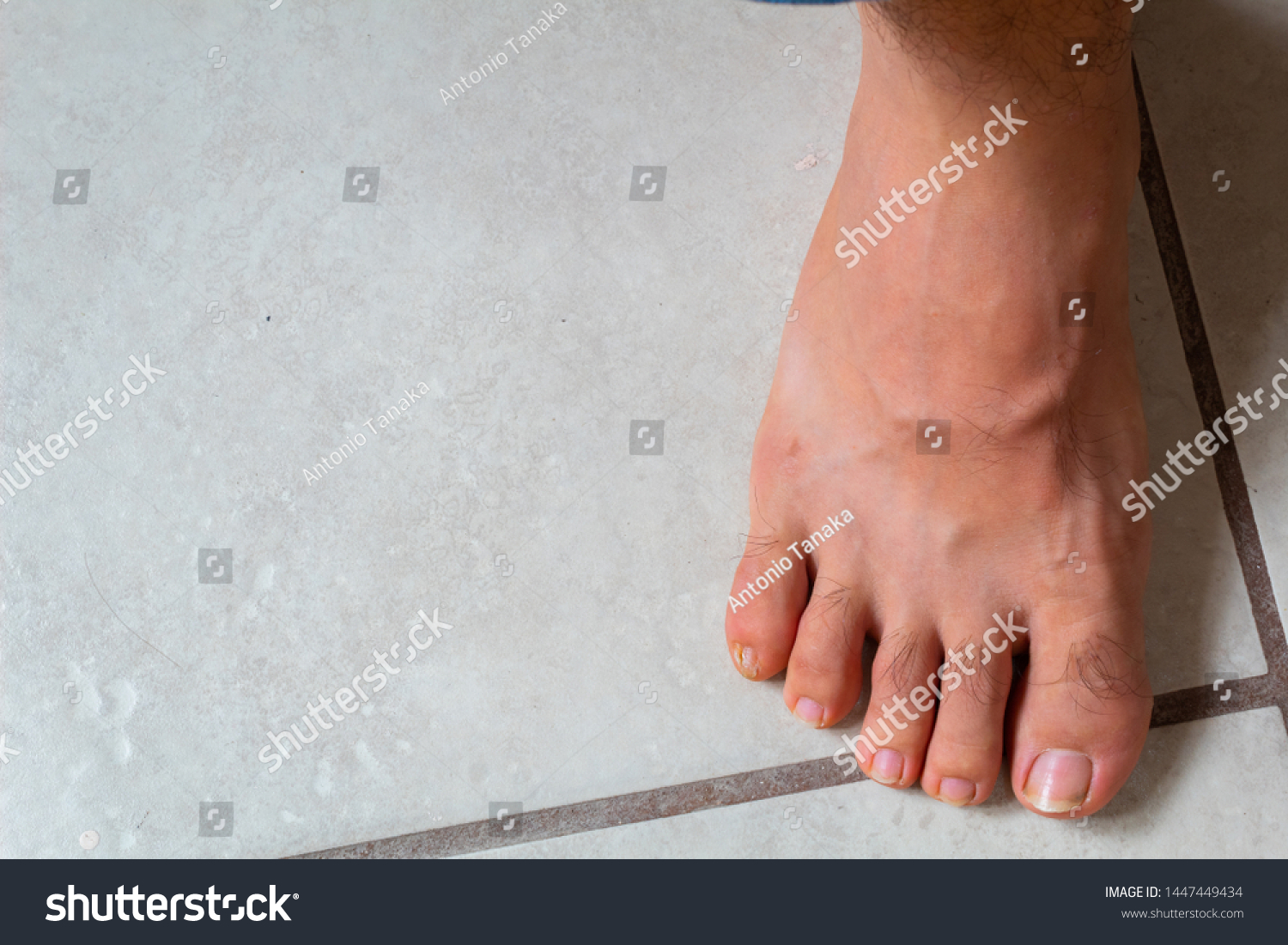 Close Feet Wound On Small Finger Stock Photo Edit Now 1447449434   Stock Photo Close Up Of Feet With A Wound On The Small Finger 1447449434 