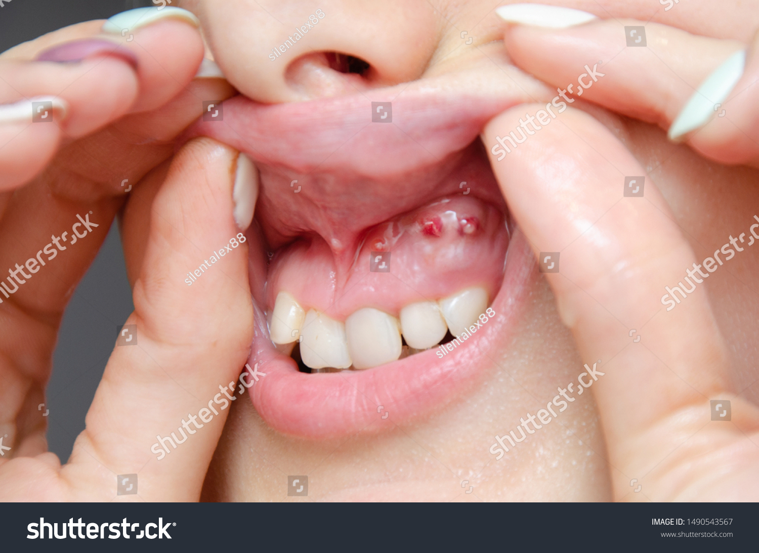 Closeup Gum Cyst Purulent Flux Disease Stock Photo Edit Now