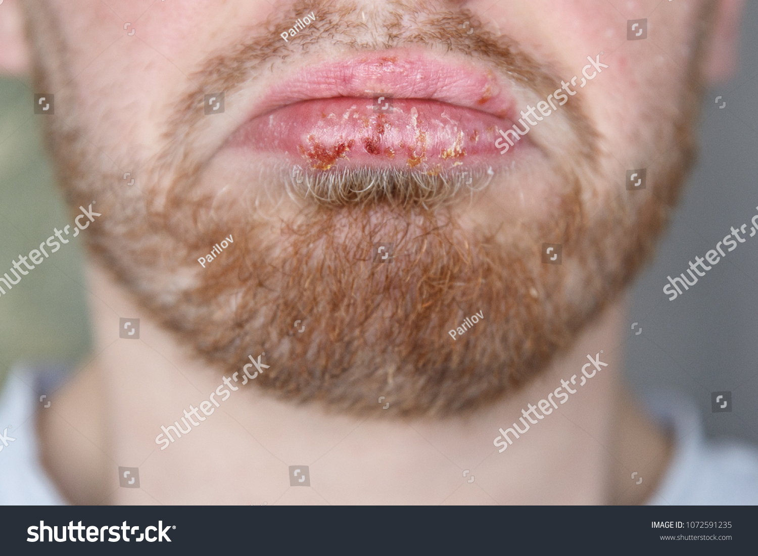 closeup herpes on lips cold man stock photo edit now 1072591235 lip diseases