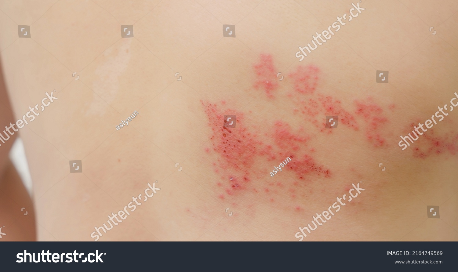 Close Man Shingles Disease On Skin Stock Photo 2164749569 | Shutterstock