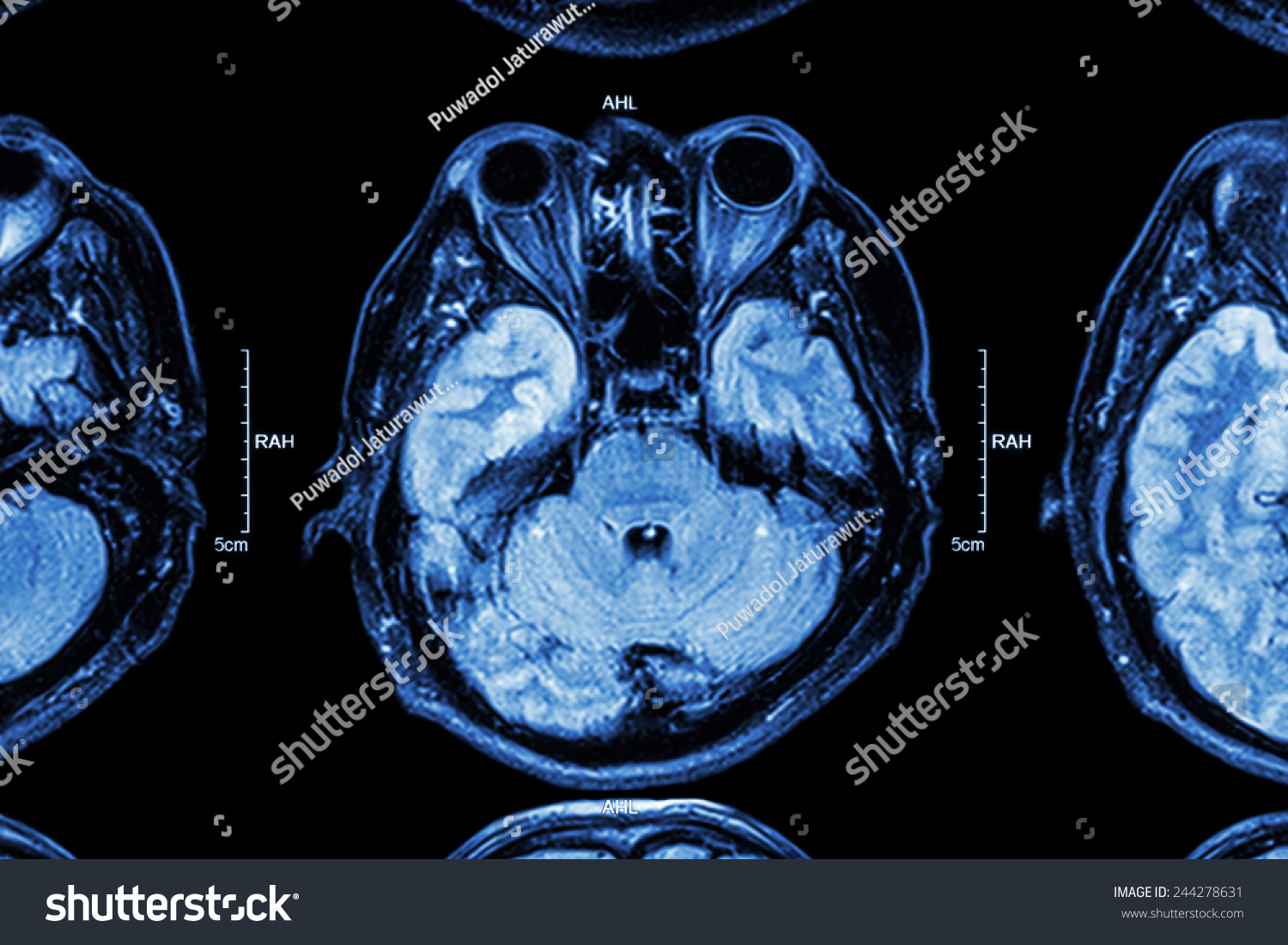 Close Up Of Mri Brain : Lower Part Of Brain ( Eyes , Temporal Lobe Of ...