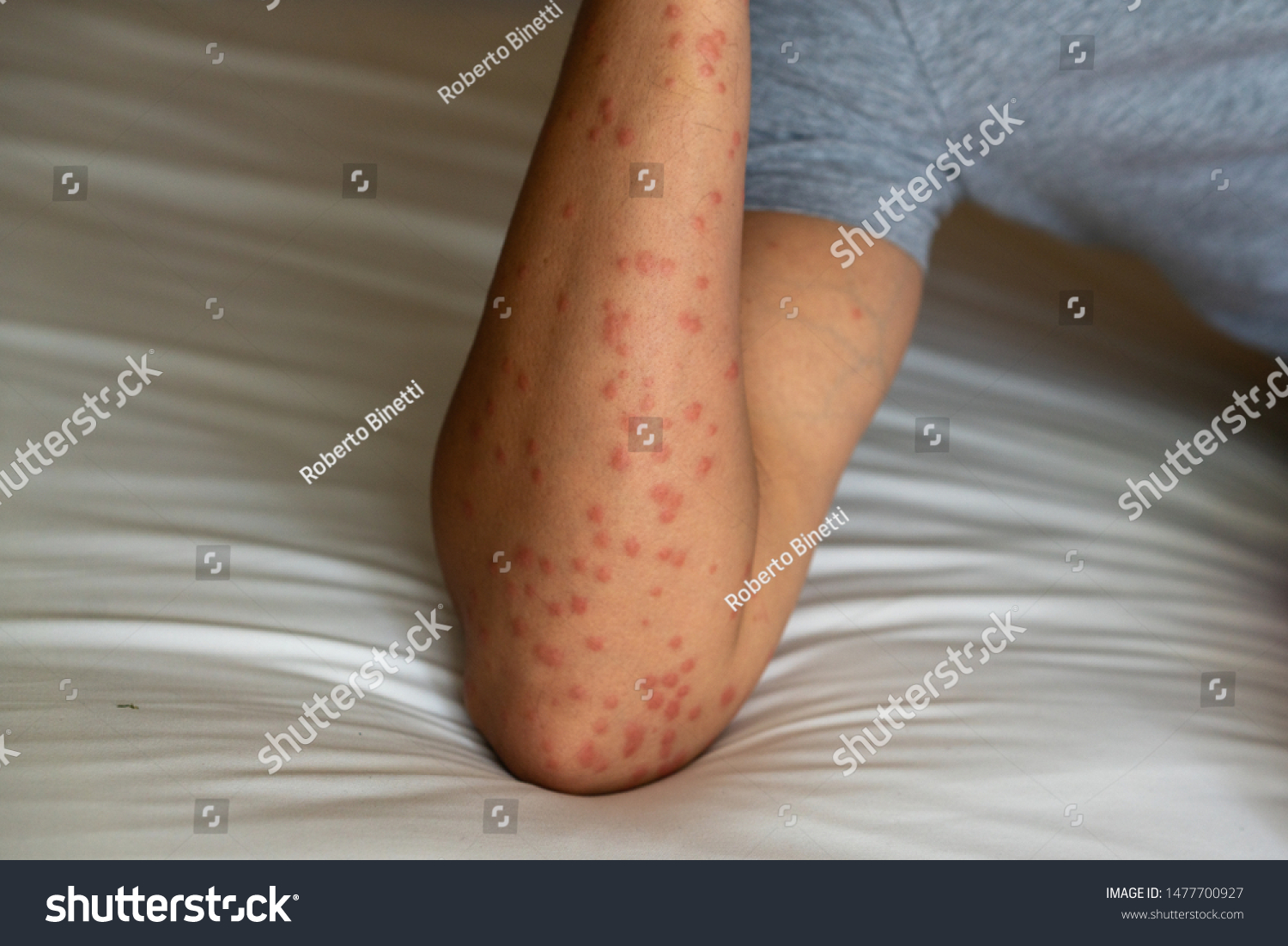 papular-urticaria-images-stock-photos-vectors-shutterstock