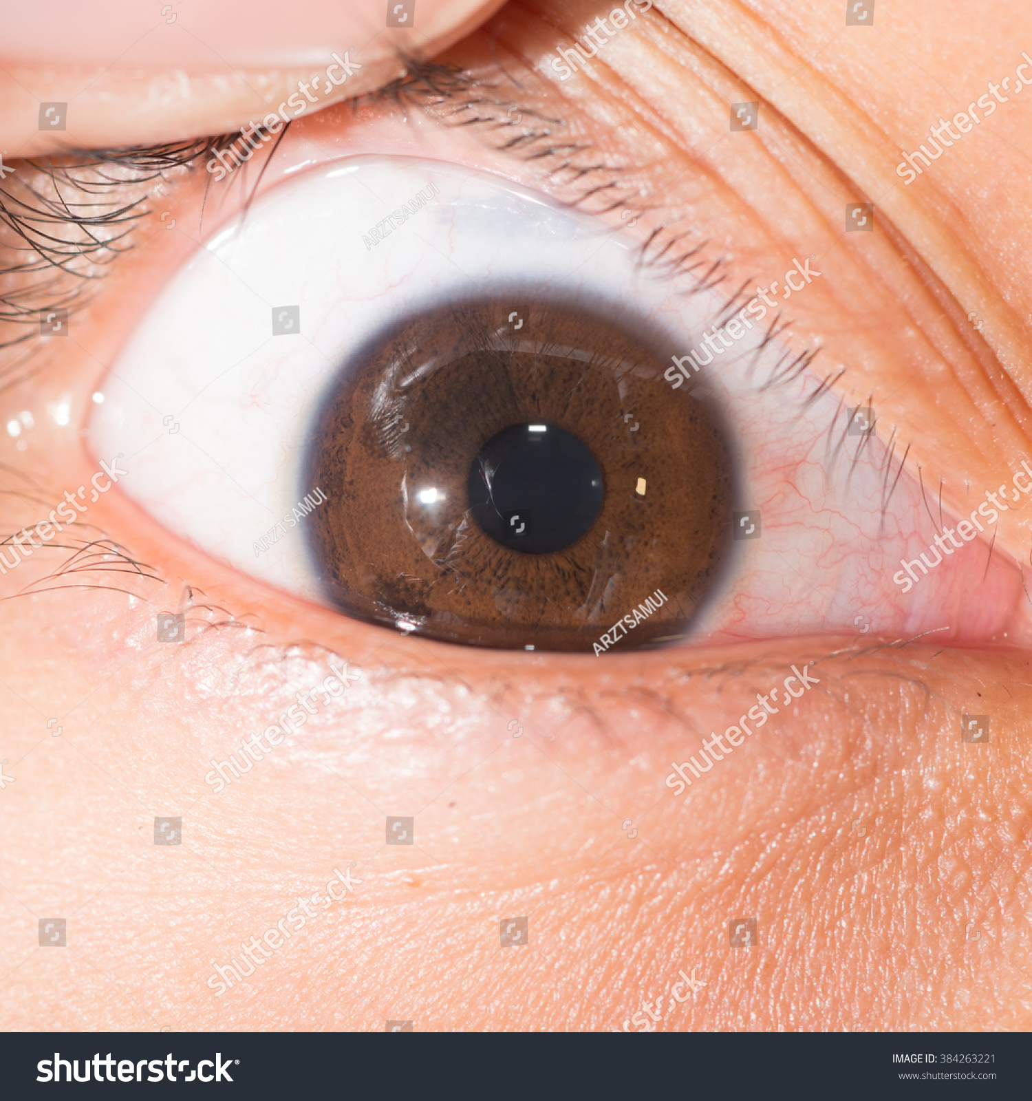 Close Up Of The Iris Nodule During Eye Examination. Stock Photo ...