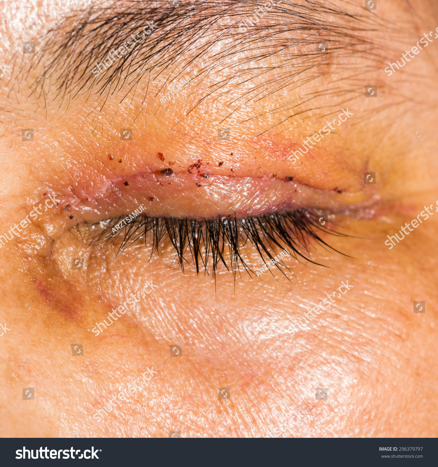 footprints sand along suoi stock photo 546483796 post blepharoplasty during eye examination stock photo 296379797 footprints sand along suoi stock photo 546483796 post blepharoplasty during eye examination stock photo 296379797
