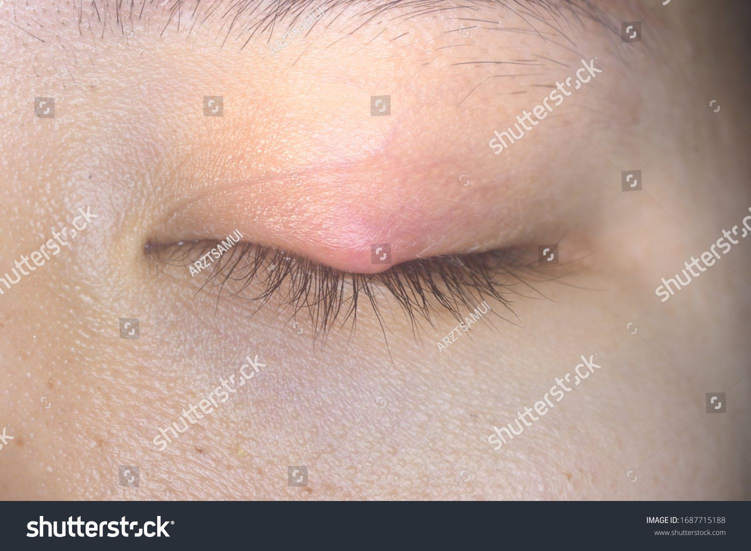 Close Stye Hordeolum Chalazion Eyelid Infection Foto Stok 1687715188