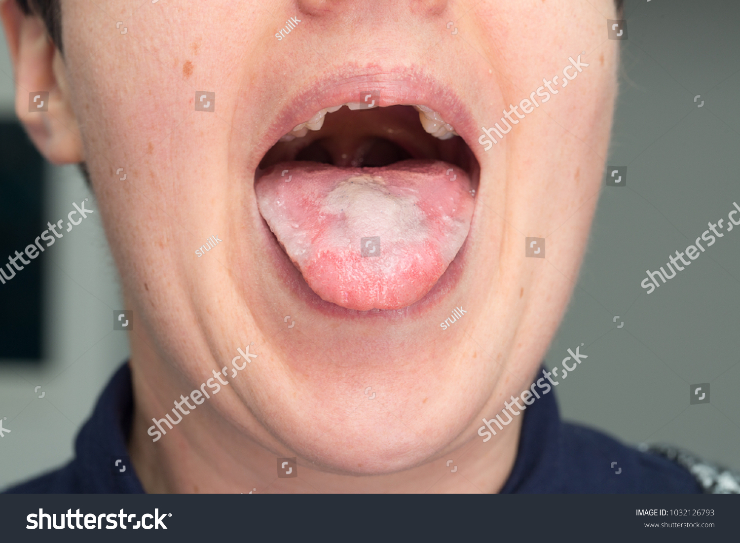 Close Tongue Infected By Candida Albicans Stock Photo Edit Now 1032126793