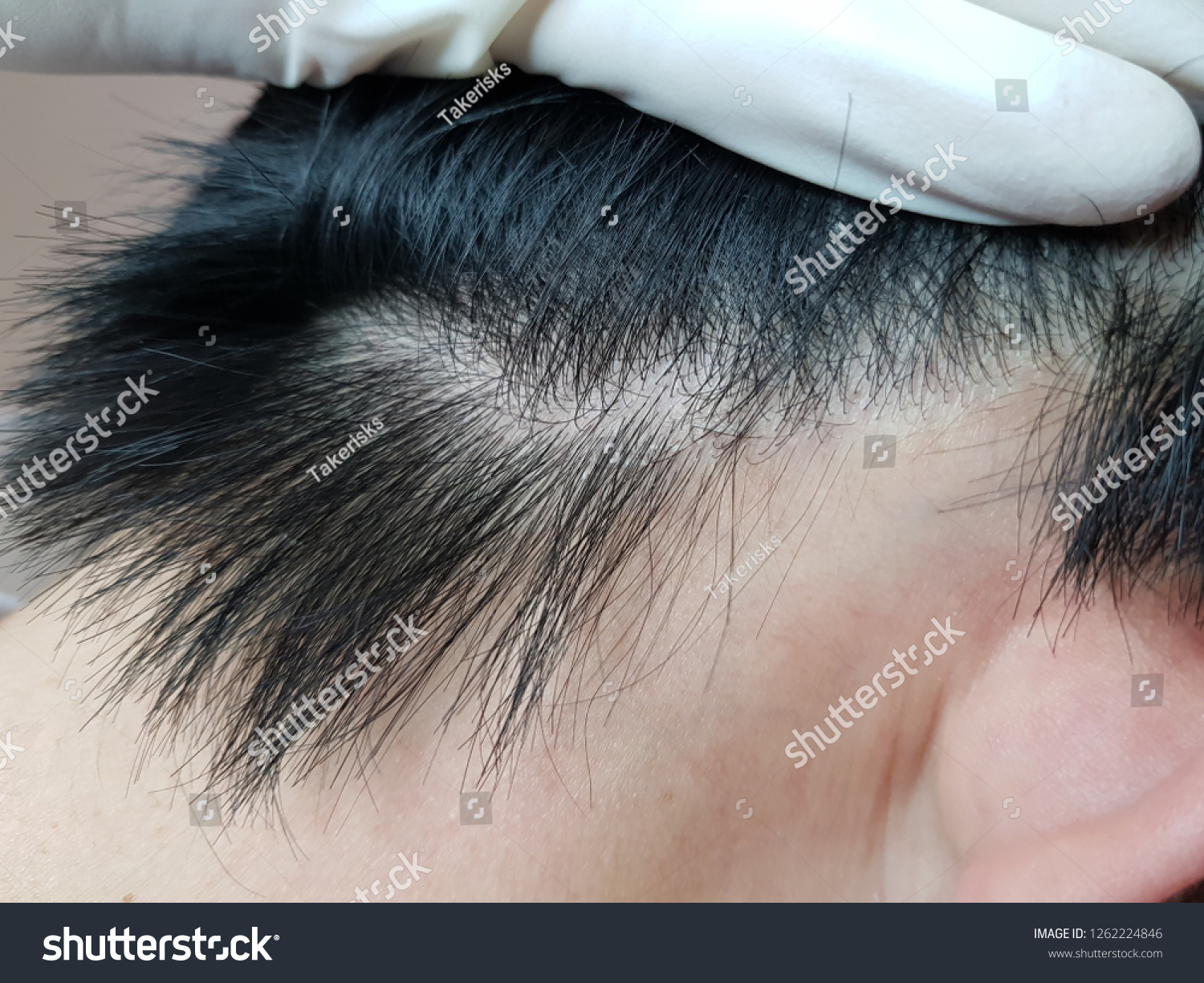 Close On Damaged Skin On Head Stock Image Download Now