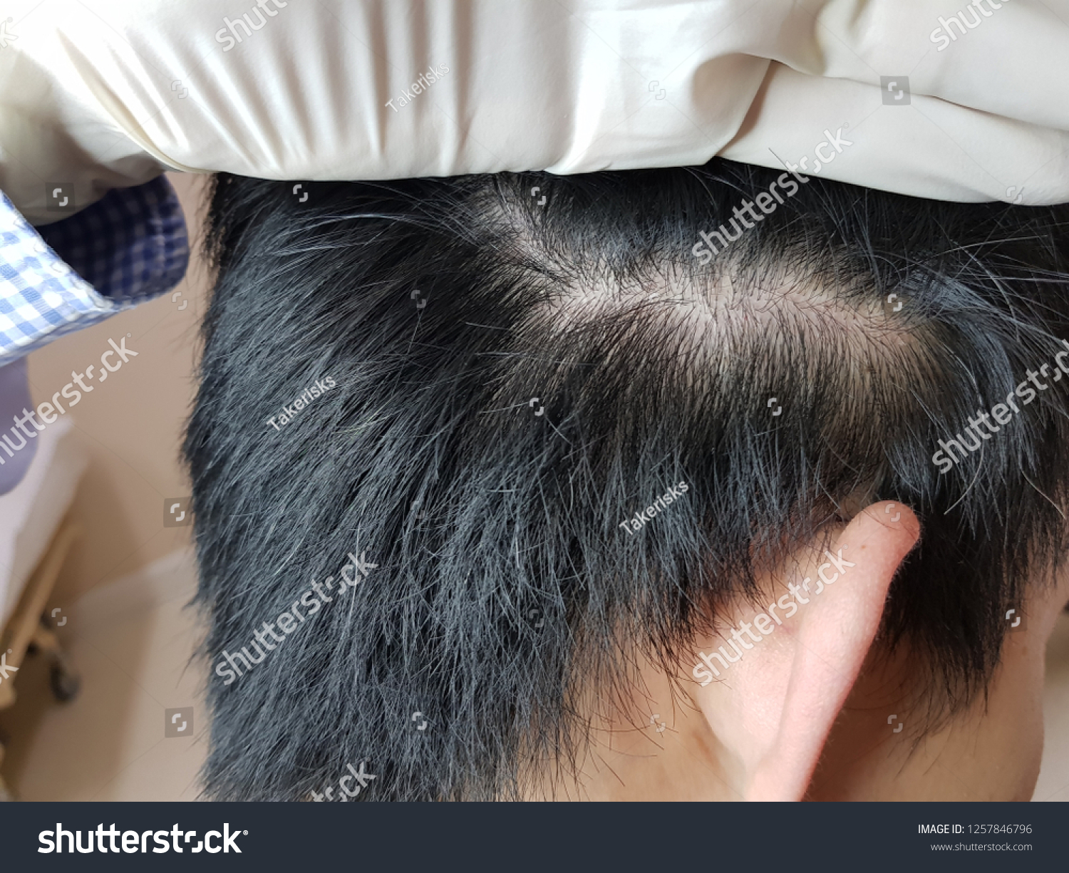 Close On Damaged Skin On Head Stock Image Download Now