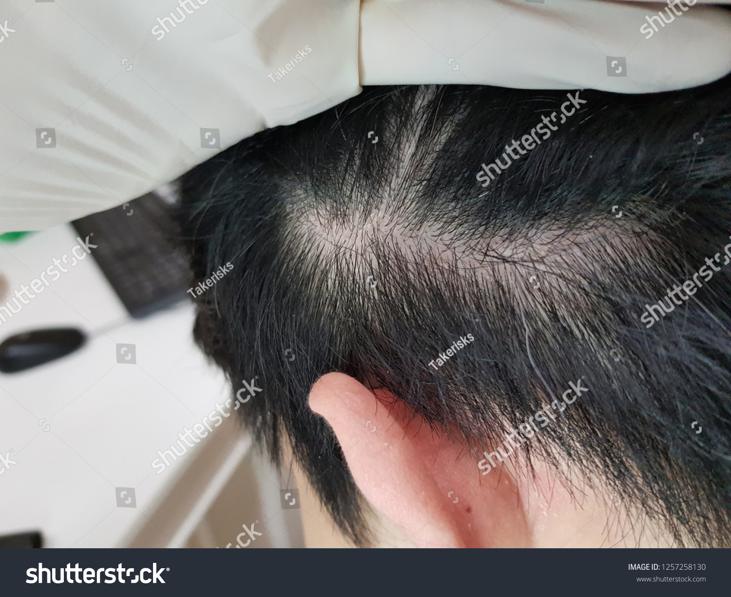 Close On Damaged Skin On Head Stock Photo Edit Now 1257258130