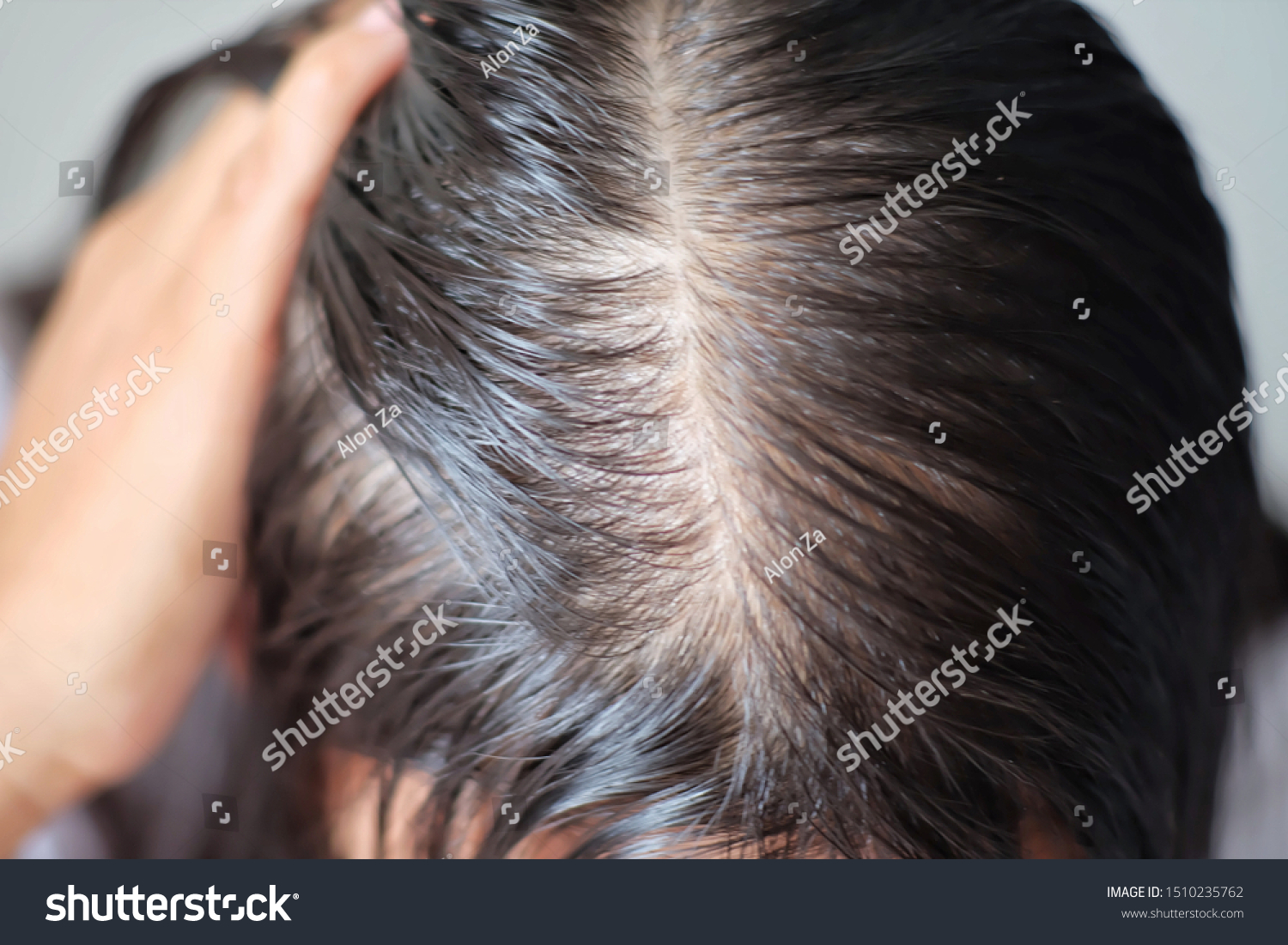 Close Thin Hair On Scalp Head Stock Image Download Now