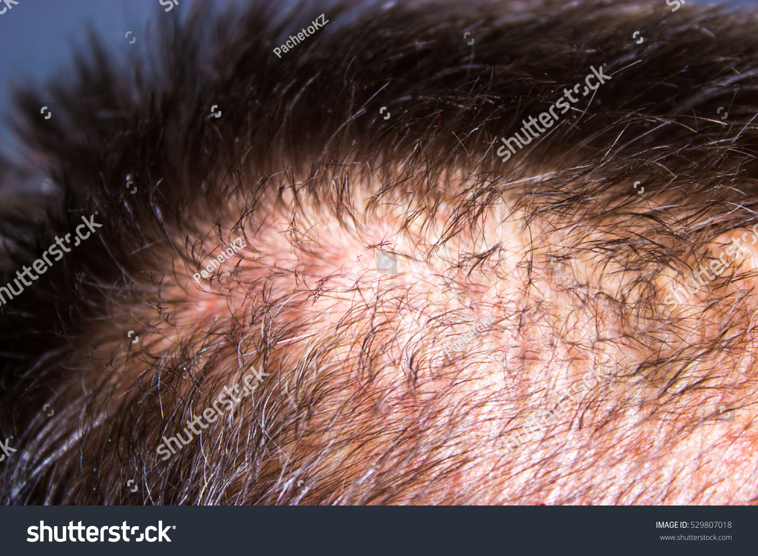 Closeup Circular Hair Loss Back Head Stock Photo 529807018