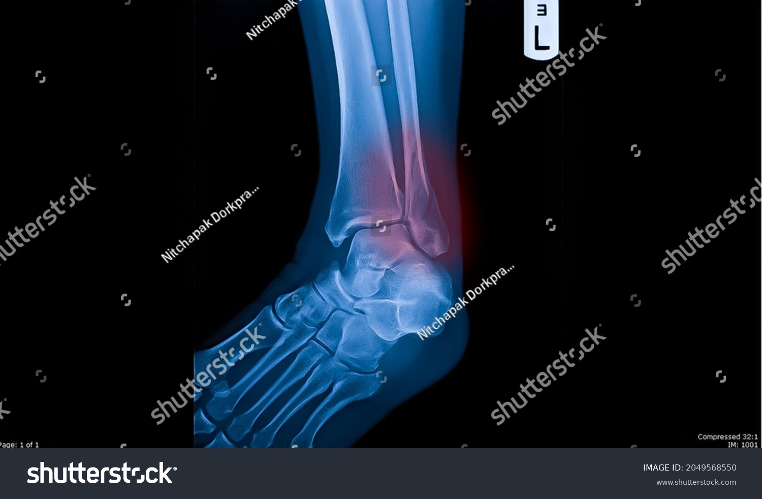 malleolus-images-photos-et-images-vectorielles-de-stock-shutterstock