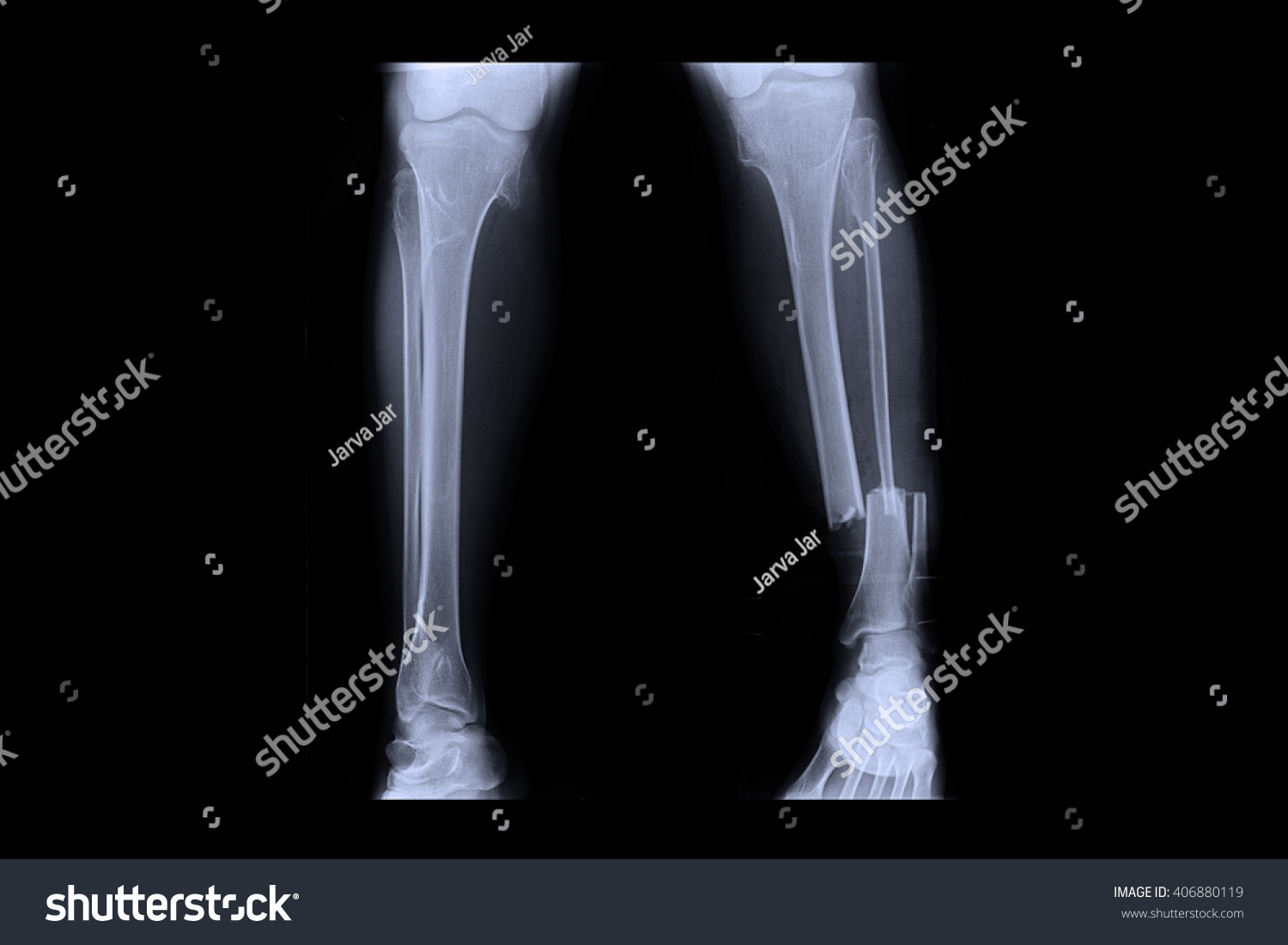 Xray Human Broken Leg After Surgery Stock Photo Edit Now