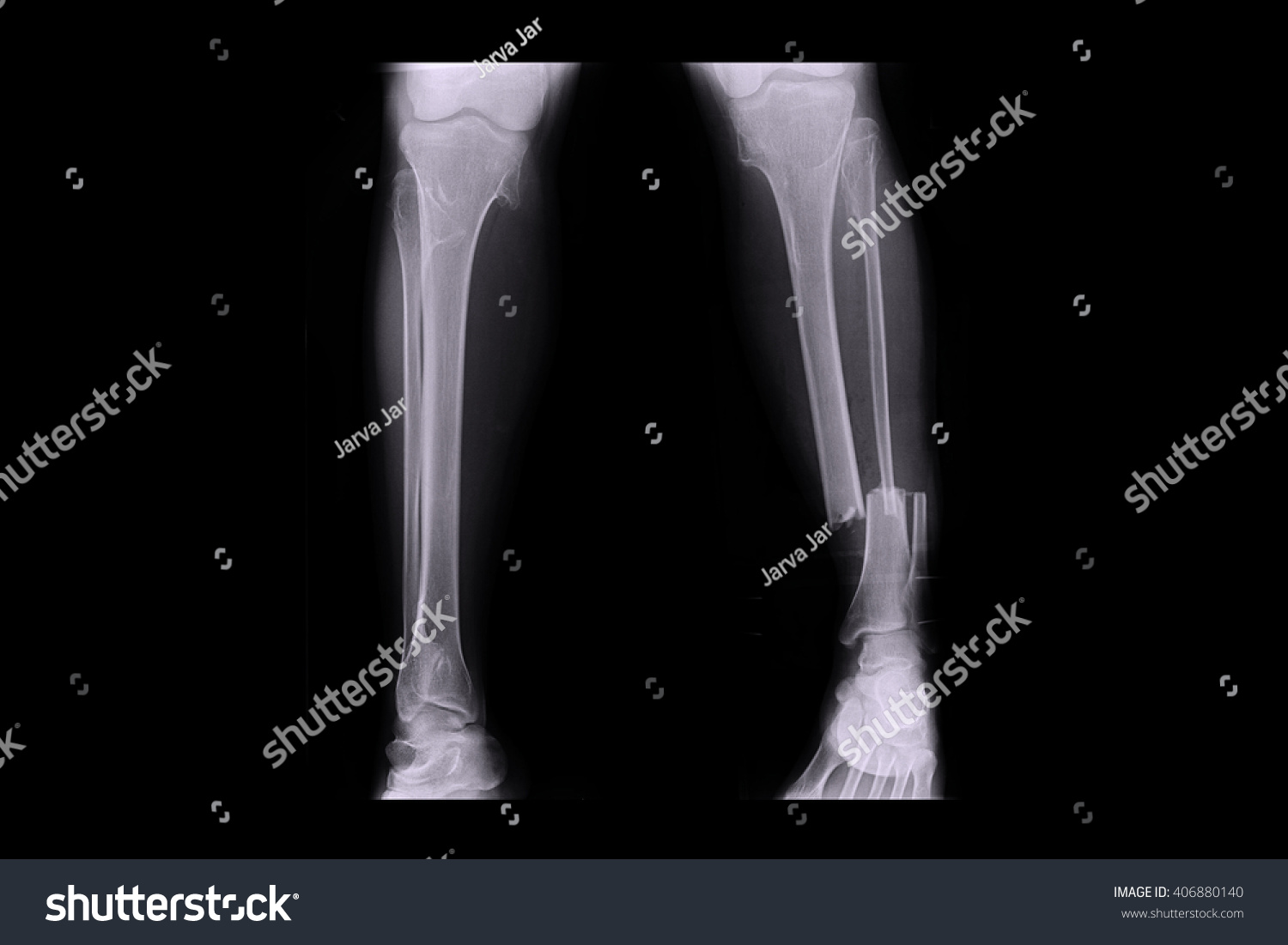 4.751 Broken leg xray immagini, foto stock e grafica vettoriale