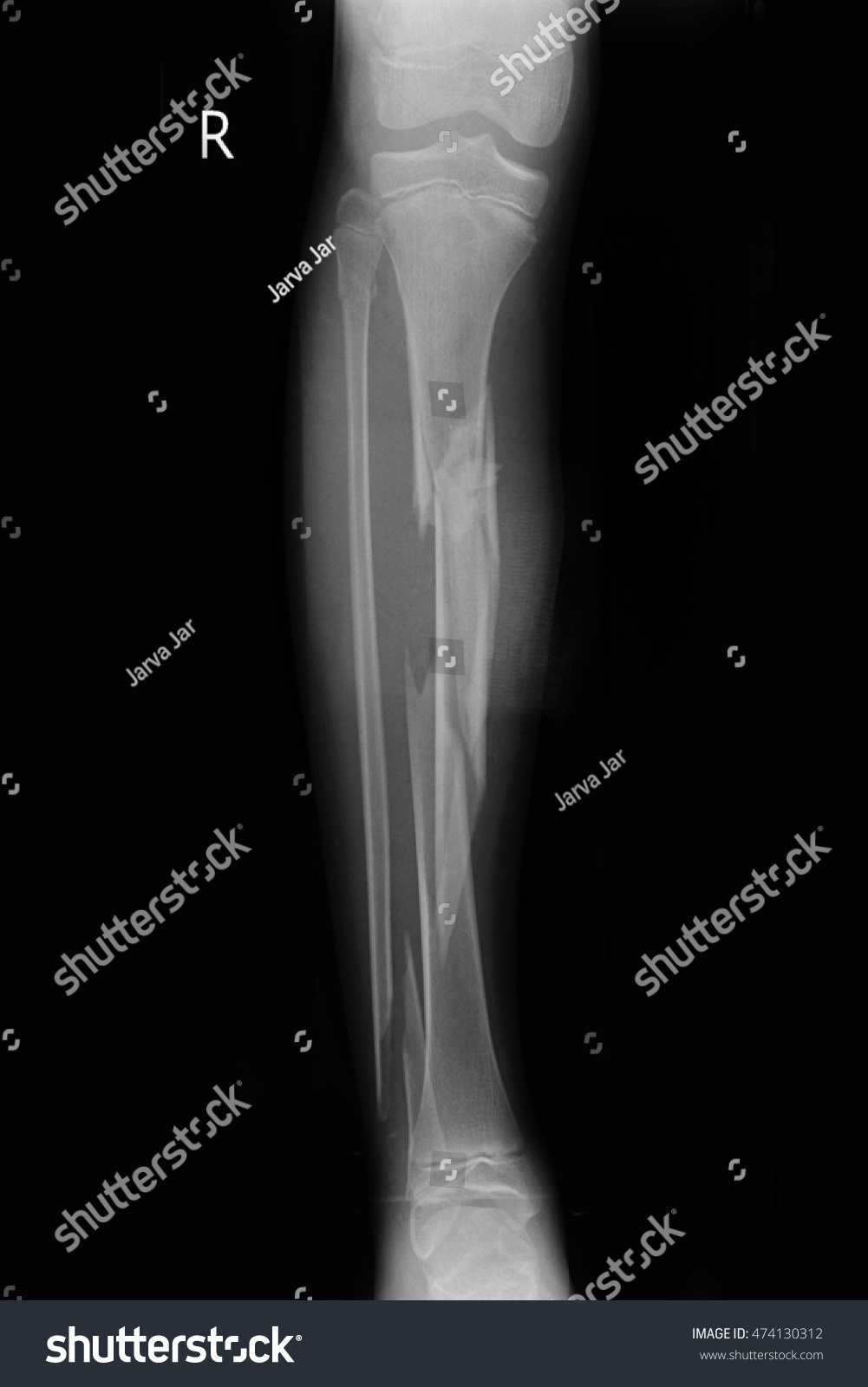 icd 10 closed fracture tibia fibula