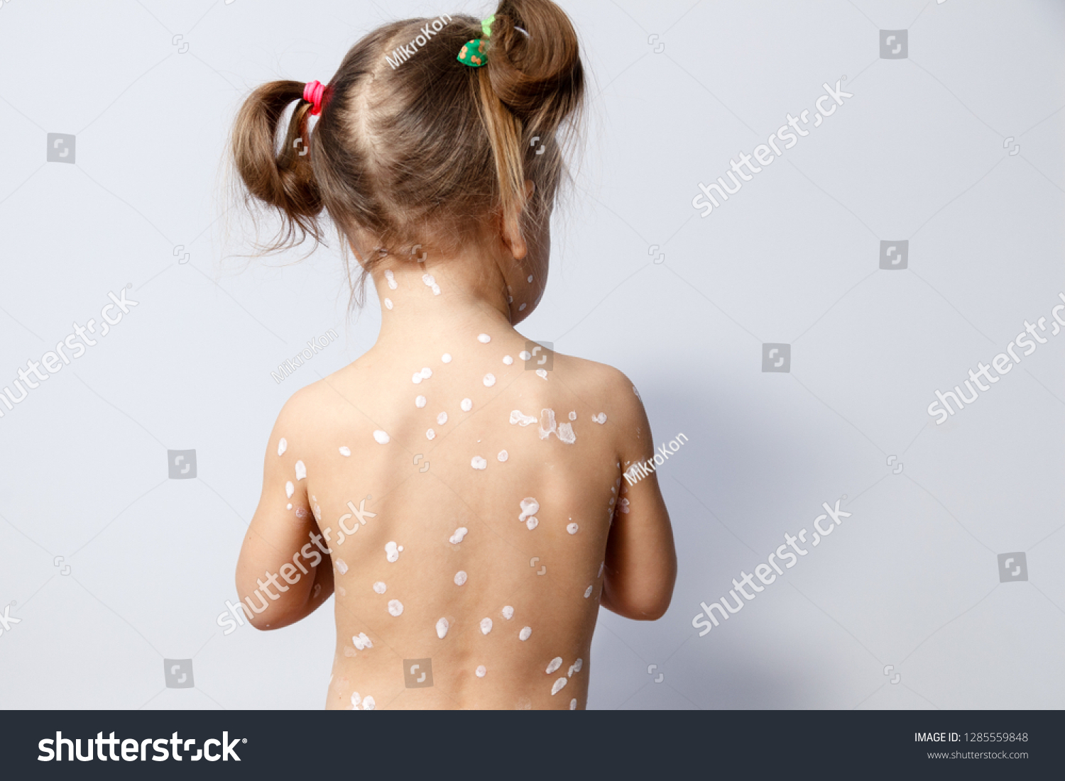  little girl chickenpox 