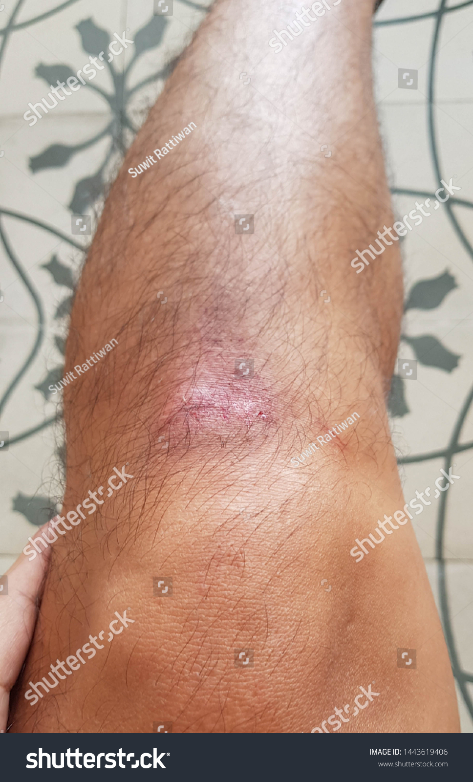 Closeup Bleeding Wound Mans Knee Male Stock Photo Edit Now 1443619406