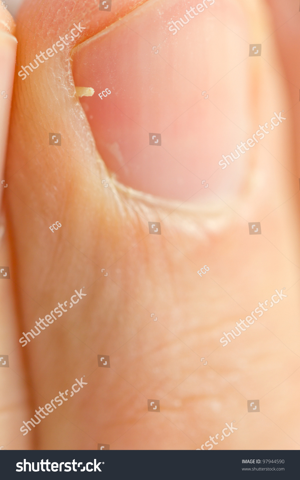 Closeup Macro Finger Hangnail Stock Photo 97944590 - Shutterstock
