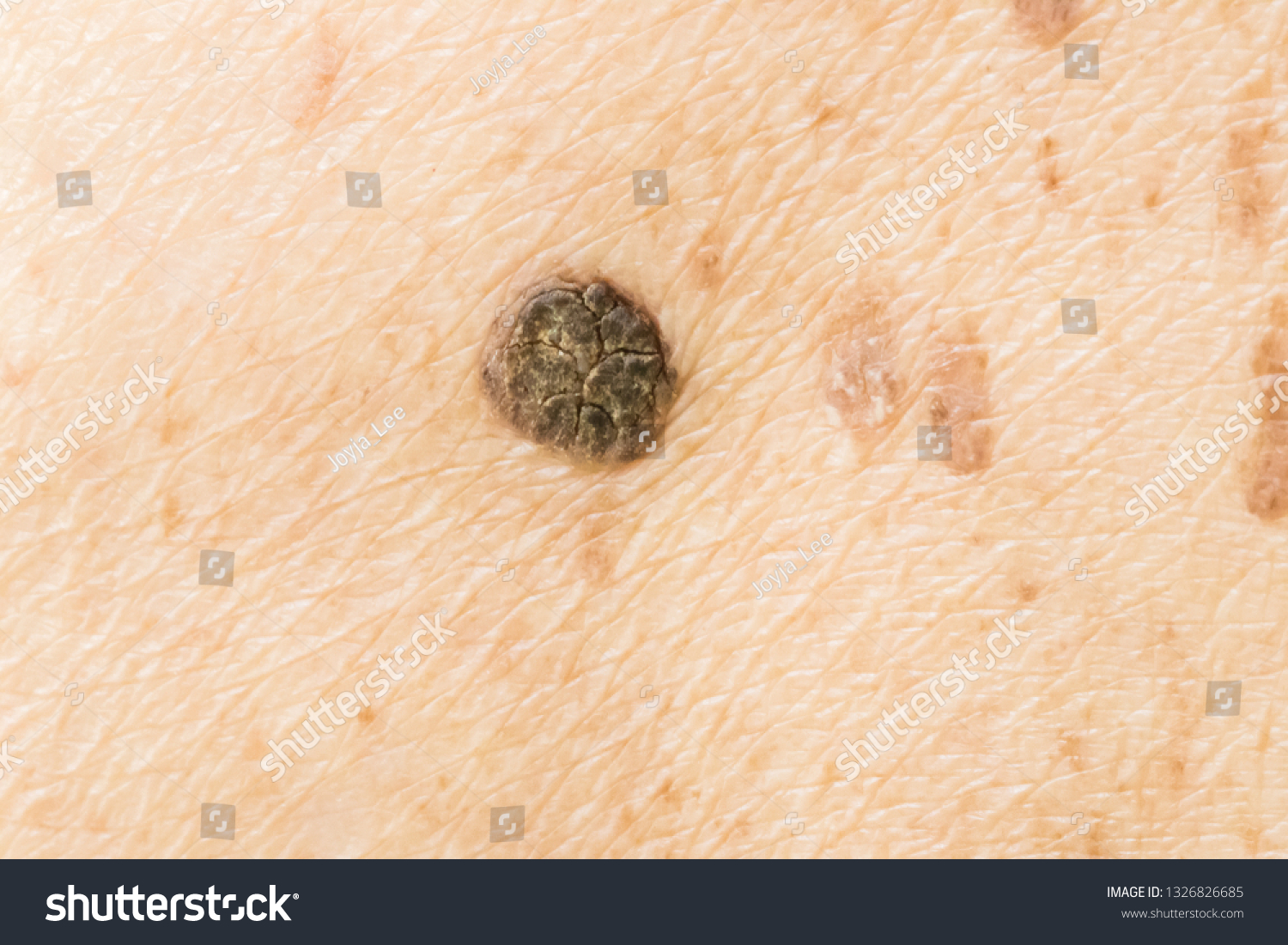 Closeup Age Spots Skin Liver Spots Stock Photo Edit Now