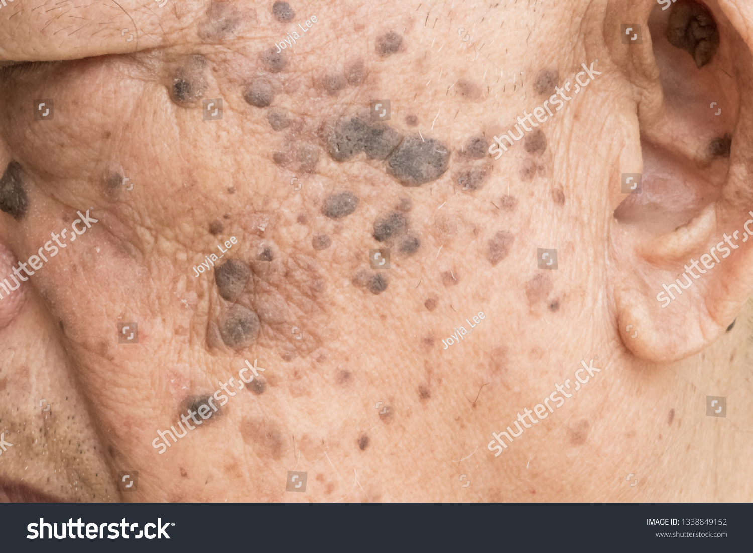 Closeup Age Spots Skin Liver Spots Stock Photo Edit Now
