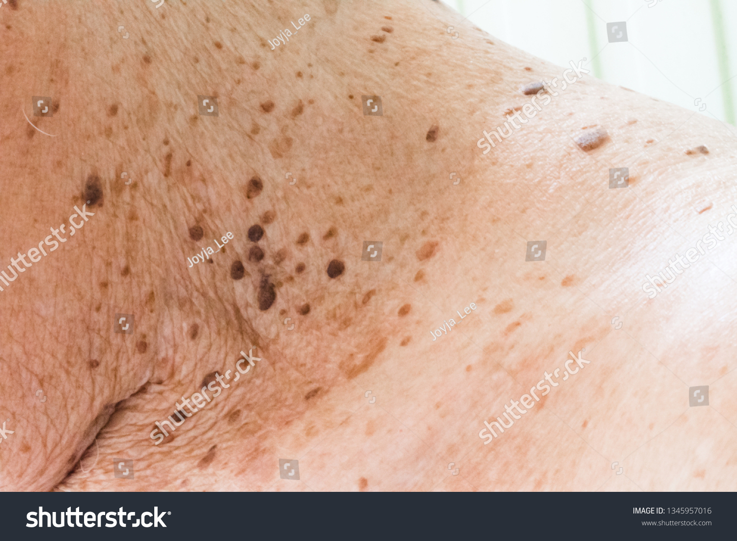 Closeup Age Spots Skin Liver Spots Stock Photo Edit Now