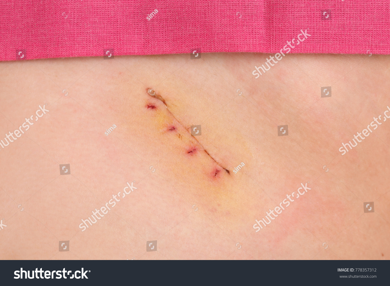 Closeup Fresh Appendix Surgery Scar Appendectomy Stock Photo Shutterstock