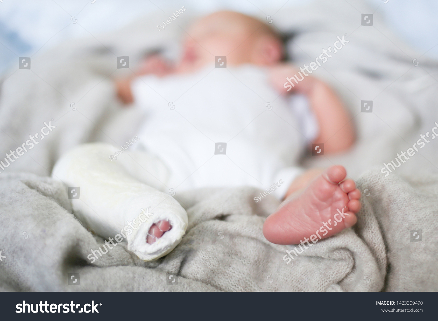 Closeup Newborn Little Baby Leg Cast Stock Photo Edit Now