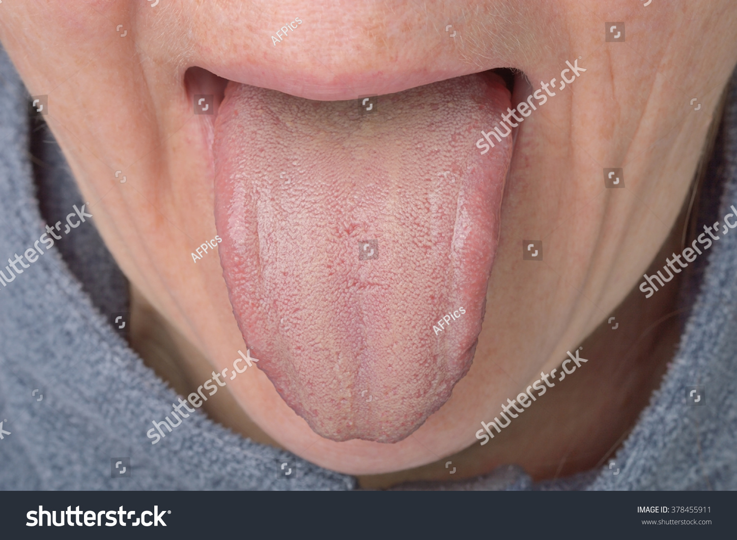 Coated Protruded Tongue Stock Photo 378455911 : Shutterstock