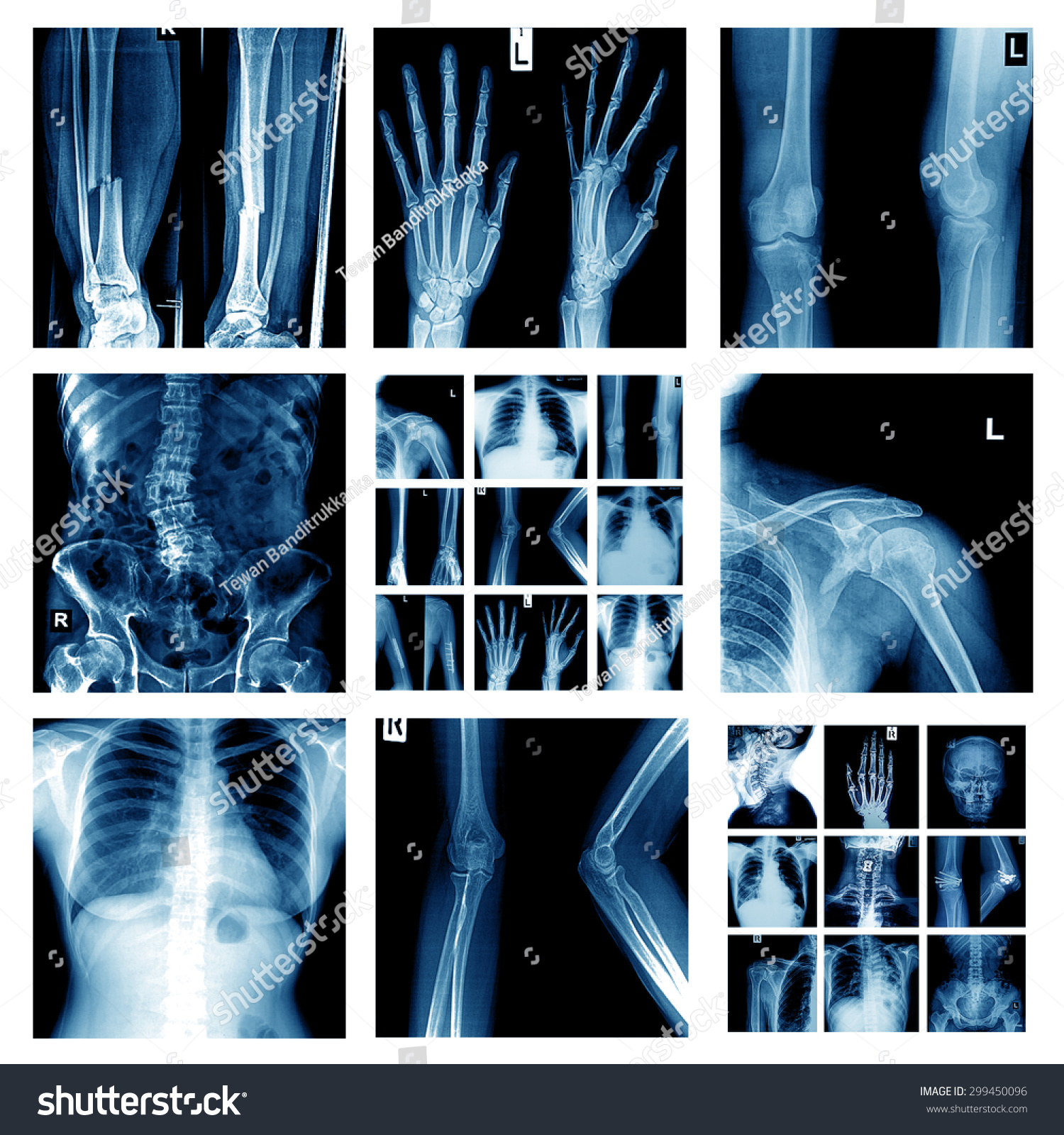 Collection Xray Multiple Part Humanorthopedic Surgery Stock Photo ...