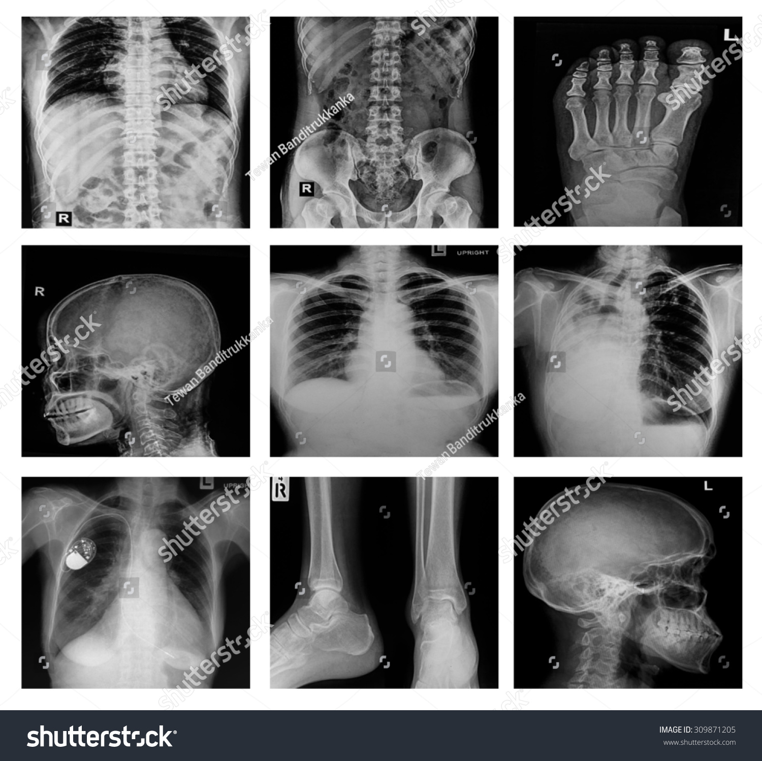 Collection X-Ray Multiple Part Of Human,Orthopedic Surgery And Multiple ...