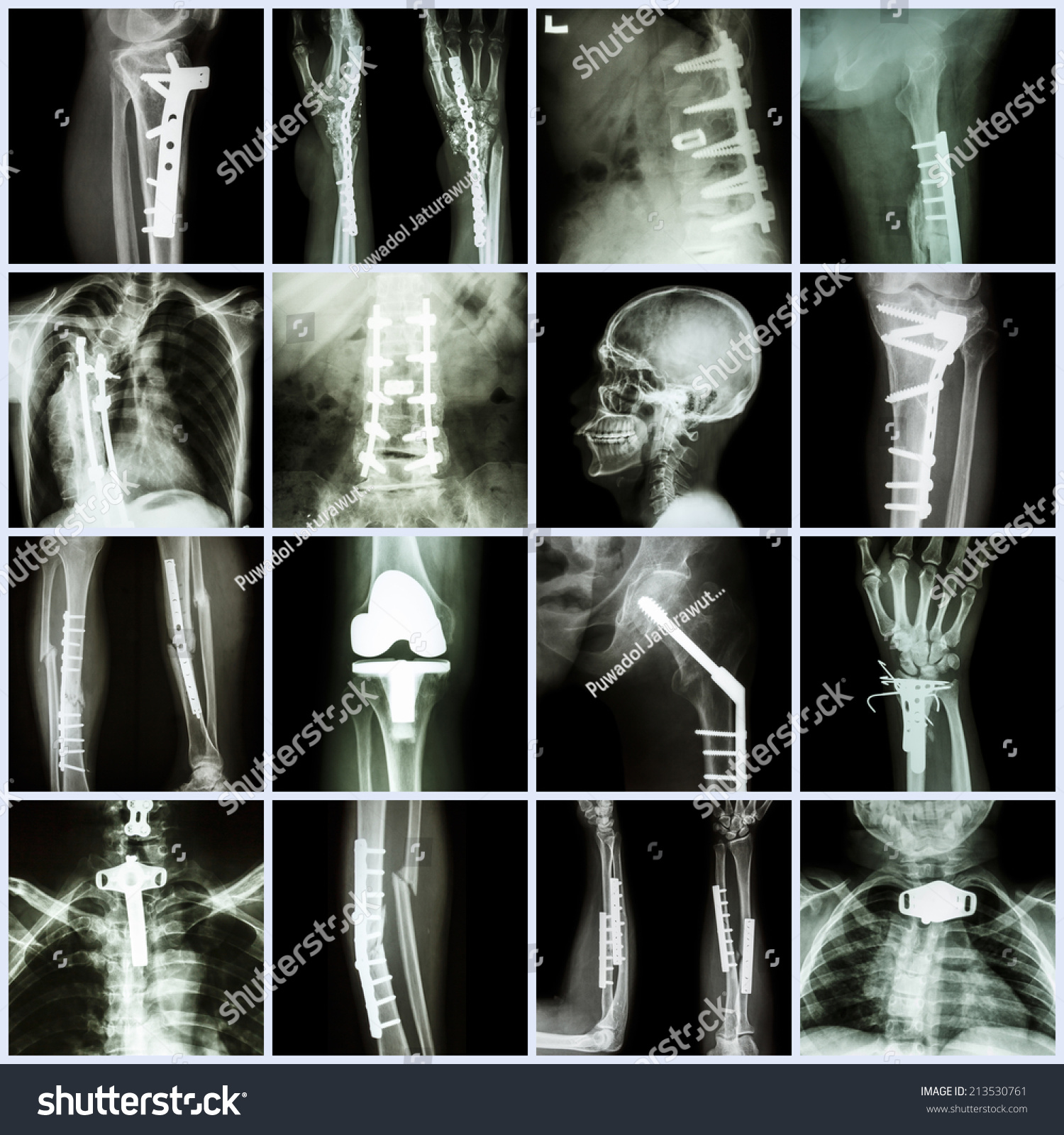 Collection Xray Orthopedic Surgery Multiple Part Stock Photo (edit Now 